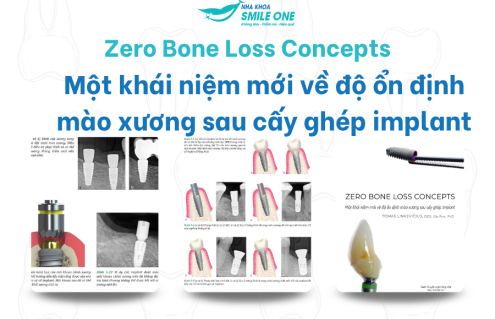 Zero Bone Loss Concepts – Một khái niệm mới về độ ổn định mào xương sau cấy ghép implant